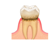 歯肉炎の治療
