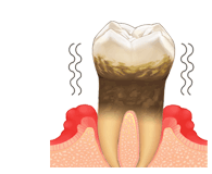 歯周病の治療