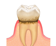 歯肉炎の治療 