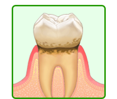 痛くない歯肉炎の治療なら奈良県大和郡山市の福本歯科医院