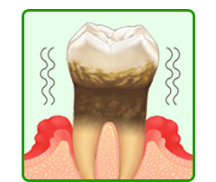 痛くない歯周病治療なら奈良県大和郡山市の福本歯科医院